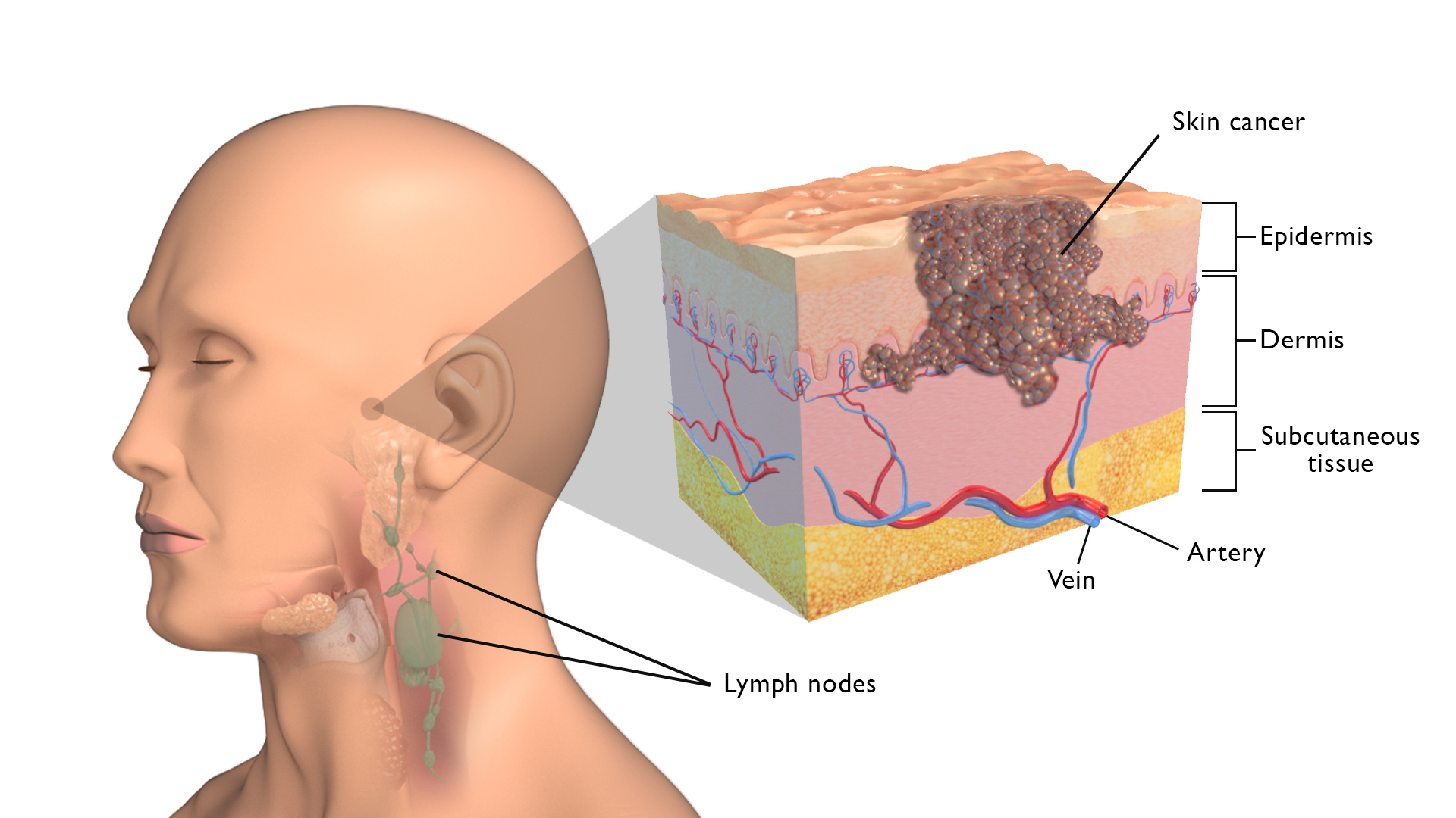 Skin Cancer on the Face - Head and Neck Cancer Australia